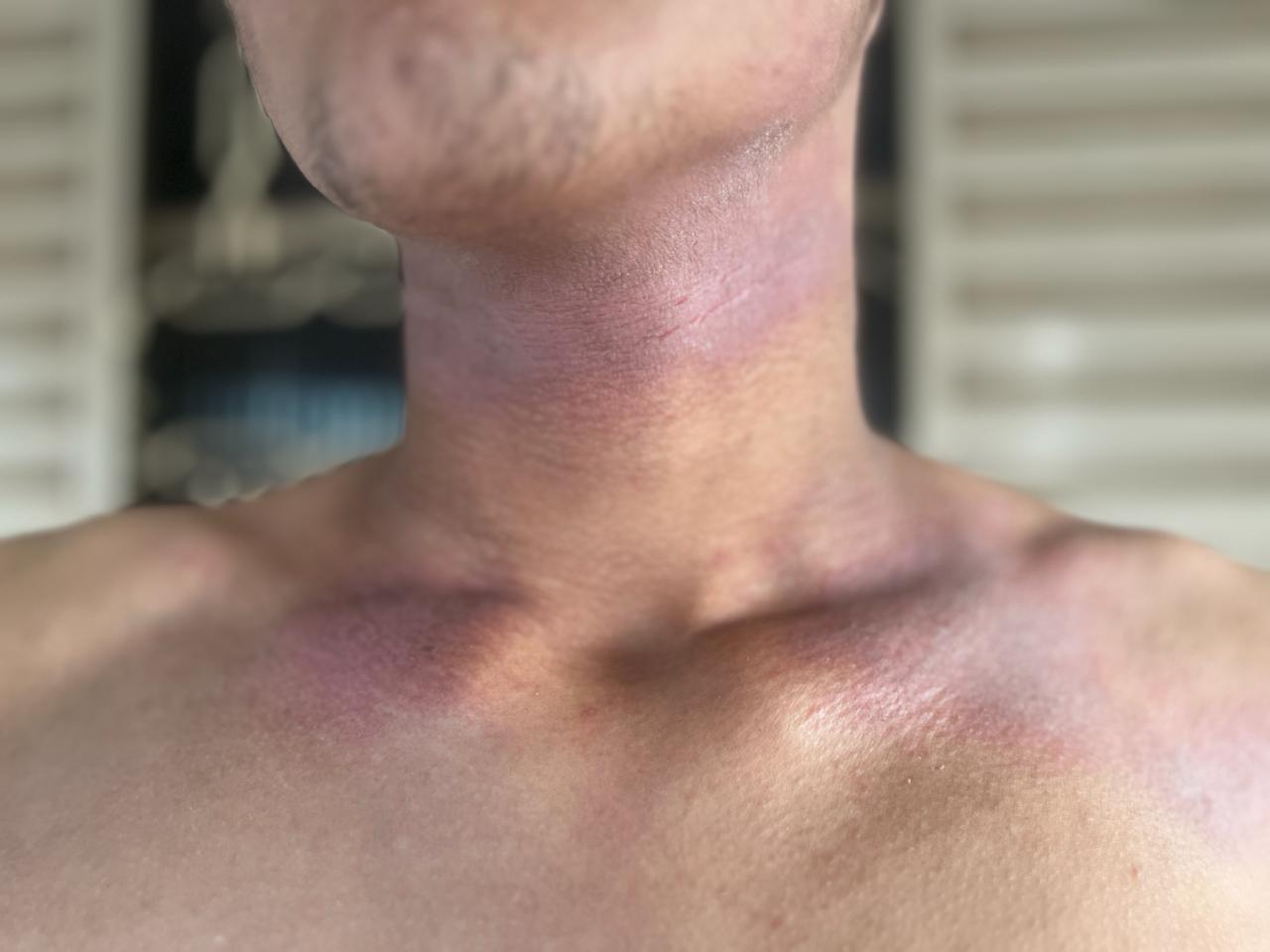 Cartilha ajuda a combater preconceito contra a dermatite atópica